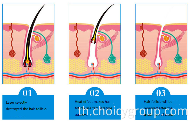 Diode Laser Hair Removal Beauty Equipment